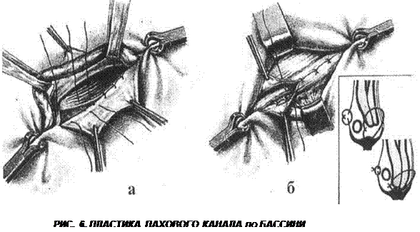 Операция Паховой Грыжи Диета