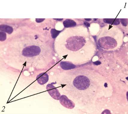 Клетки метаплазированного эпителия с реактивными изменениями