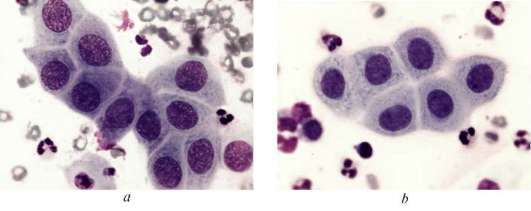 Метаплазированный эпителий шейки. Плоскоклеточная метаплазия цитология. Клетки метаплазированного эпителия с реактивными изменениями