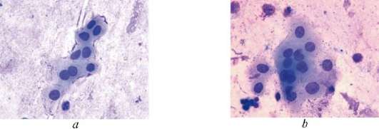 Клетки метаплазированного эпителия с реактивными изменениями
