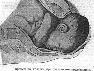 роды в затылочном предлежании. задний вид затылочного предлежания биомеханизм родов. головное предлежание плода лицевое. роды в затылочном предлежании. биомеханизм родов при затылочном предлежании.