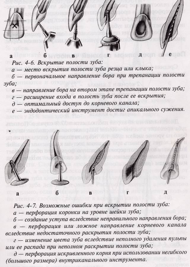 Препарирование корневого канала. Раскрытие полости зуба в молярах верхней челюсти. Методика вскрытия полости зуба. Вскрытие полости зуба Интак. Центральный резец верхней челюсти эндодонтия.