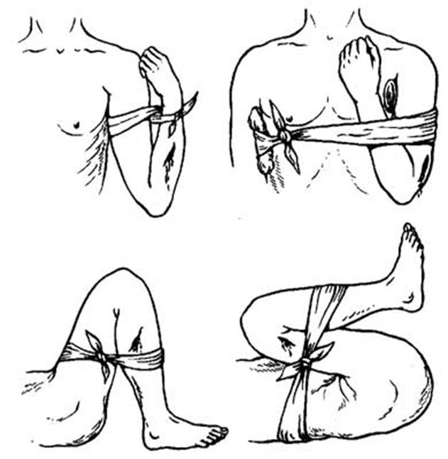 Способы наложения повязок при кровотечении. Накладывание повязки при кровотечении. Наложение кровоостанавливающего жгута. Наложение кровоостанавливающей повязки. Повязка для остановки кровотечения.