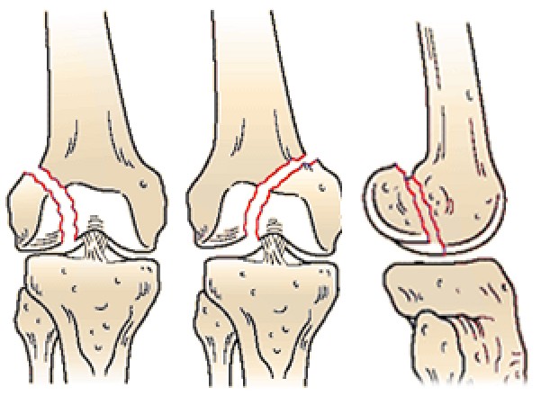 Повреждения мыщелка бедренной кости