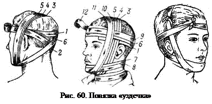 Наложение повязки уздечка. Пращевидная повязка при переломе челюсти. Повязка на челюсть бинт. Повязка уздечка на нижнюю челюсть. Повязка уздечка накладывается