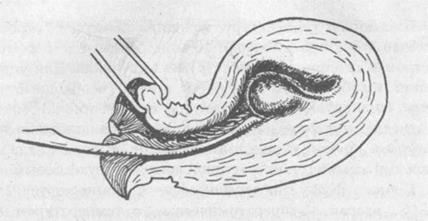 Выскабливание цервикального канала и полости