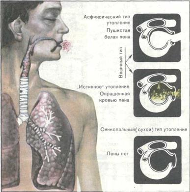 Что значит пена изо рта. Асфиксическое («сухое») утопление. Асфиктическое утопление признаки. Асфиксическое утопление симптомы.