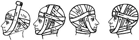 Повязка уздечка накладывается. Повязка чепец и уздечка. Перевязка головы чепец. Повязка на голову при травме чепец. Повязка уздечка техника наложения.