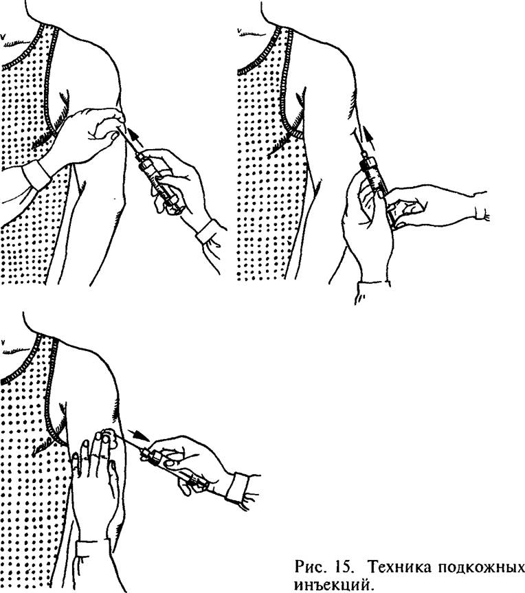 Инъекция в м п к. Подкожная инъекция в плечо алгоритм. Алгоритм подкожной инъекция подкожно. Алгоритм постановки подкожной инъекции в плечо. Укол подкожно техника выполнения.