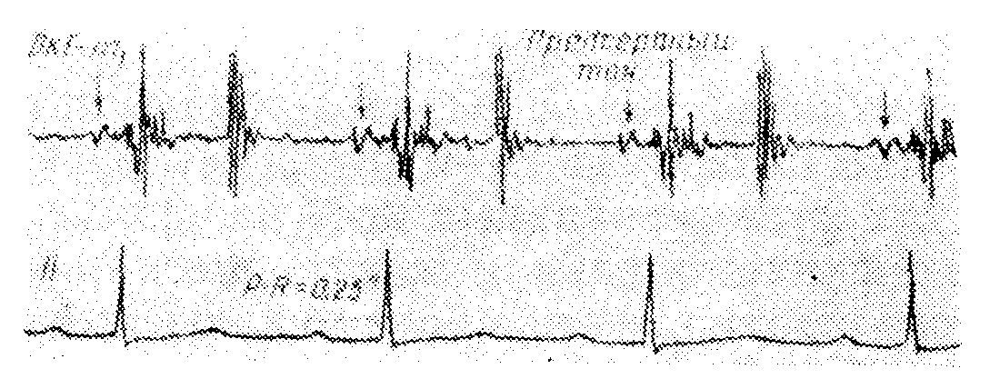 Предсердная блокада. Атриовентрикулярная задержка.
