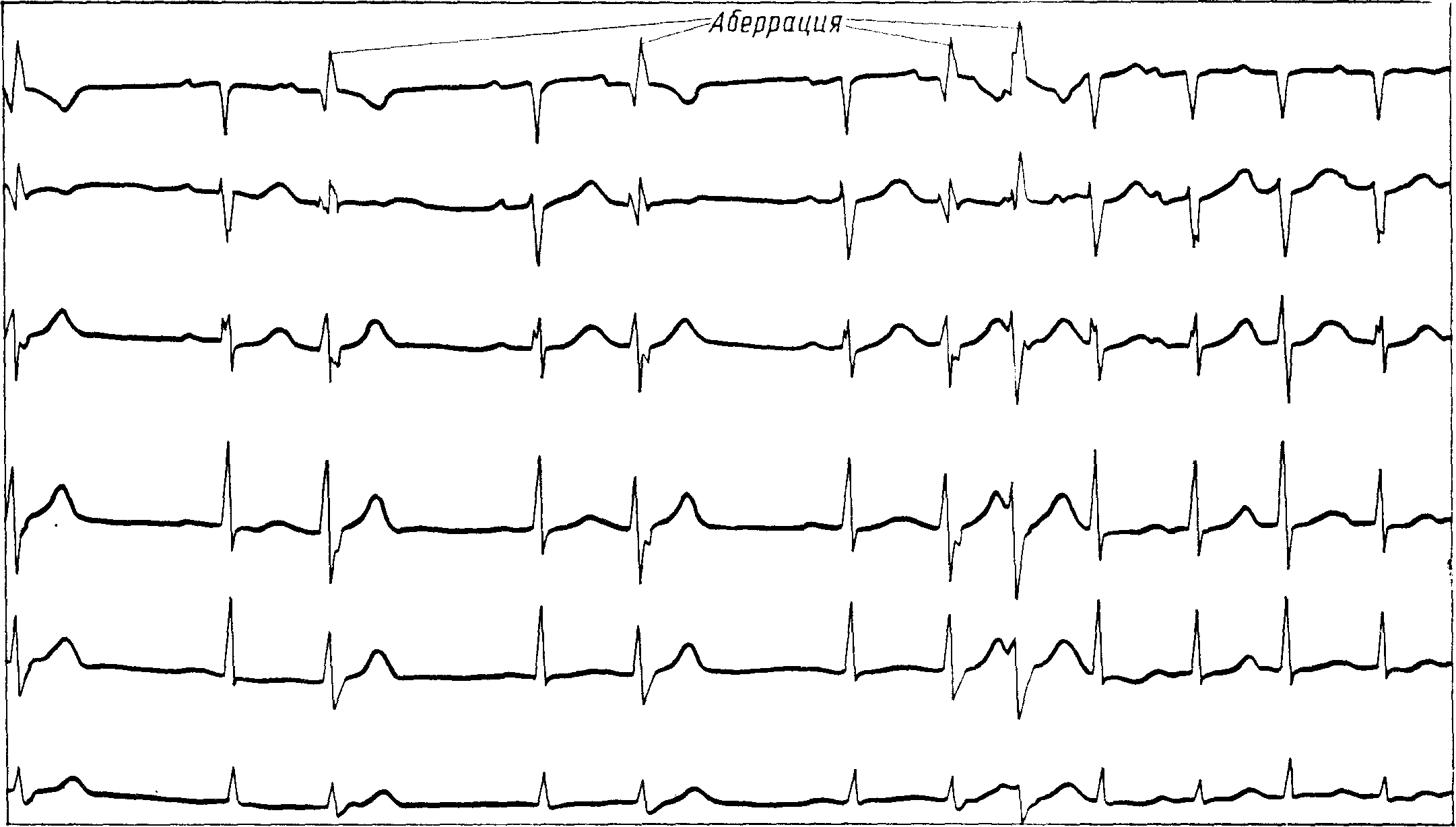 Абберантные предсердные экстрасистолы