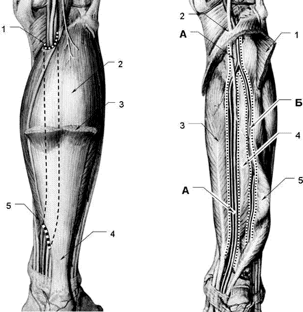 Нижний мышечно-малоберцовый канал (Canalis musculoperoneus inferior. Мышечно малоберцовый канал верхний и Нижний. Голеноподколенный канал входное отверстие. Малоберцовые каналы топография.