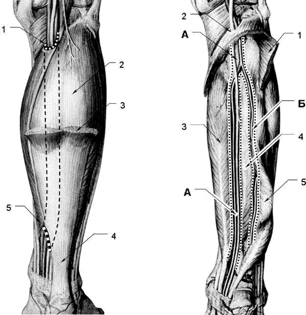 Груберов канал. Нижний мышечно-малоберцовый канал (Canalis musculoperoneus inferior. Мышечно малоберцовый канал верхний и Нижний. Голеноподколенный канал входное отверстие. Малоберцовые каналы топография.