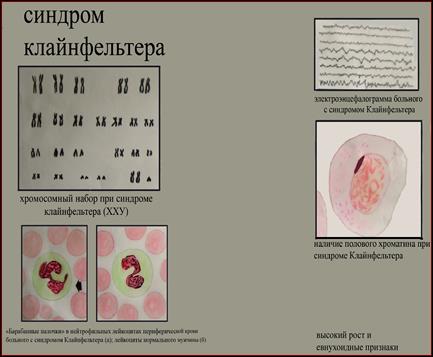 Синдром тельце. Синдром Клайнфельтера тельца Барра. Тельца Барра при синдроме Клайнфельтера. Половой хроматин при синдроме Клайнфельтера. Число Телец Барра при синдроме Клайнфельтера.