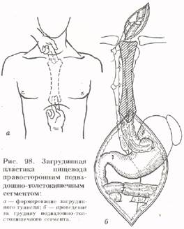 Восстановительная операция на пищеводе. Пластика пищевода по ру-Герцену-Юдину 5 этапов. Операции на пищеводе пластика пищевода. Пластика пищевода показания. Загрудинная пластика пищевода по н.и. Еремееву.