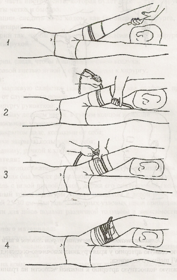 Наложение артериального жгута на нижнюю конечность. Наложение резинового жгута Эсмарха алгоритм. Наложение резинового кровоостанавливающего жгута. Техника наложения жгута Эсмарха. Наложение жгута Эсмарха при артериальном кровотечении.