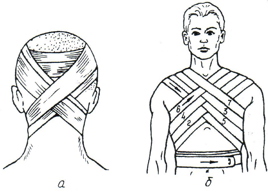 Крестообразная на затылок. Крестообразная перевязка. Десмургия восьмиобразная повязка. Десмургия крестообразная повязка. Крестообразная (восьмиобразная) повязка.