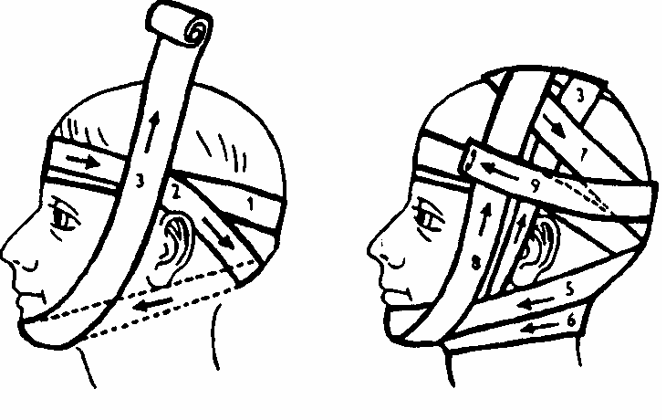 Повязка уздечка накладывается. Круговая бинтовая теменно-подбородочная повязка. Повязка уздечка техника наложения. Перевязка чепец и уздечка. Теменно подбородочная повязка Гиппократа.