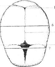 Стреловидный родничок. Стреловидный шов черепа у ребенка. Стреловидный шов новорожденного. Теменные кости плода.
