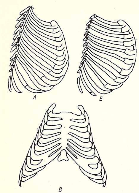 Грудная клетка ребенка 2 года. Рахитическая (куриная) грудная клетка. Рахитическая (килевидная, куриная) грудная клетка. Грудная клетка новорожденного анатомия. Форма грудной клетки у детей воронкообразная.