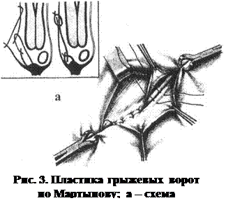 Прямая и косая паховые грыжи