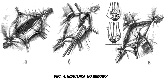 Паховая грыжа отзывы после операции. Операция грыжесечение паховой грыжи. Операция Жирара-Спасокукоцкого этапы операции. Операция по Жирару Спасокукоцкому при паховой грыже. Операция грыжесечения при косой паховой грыже.