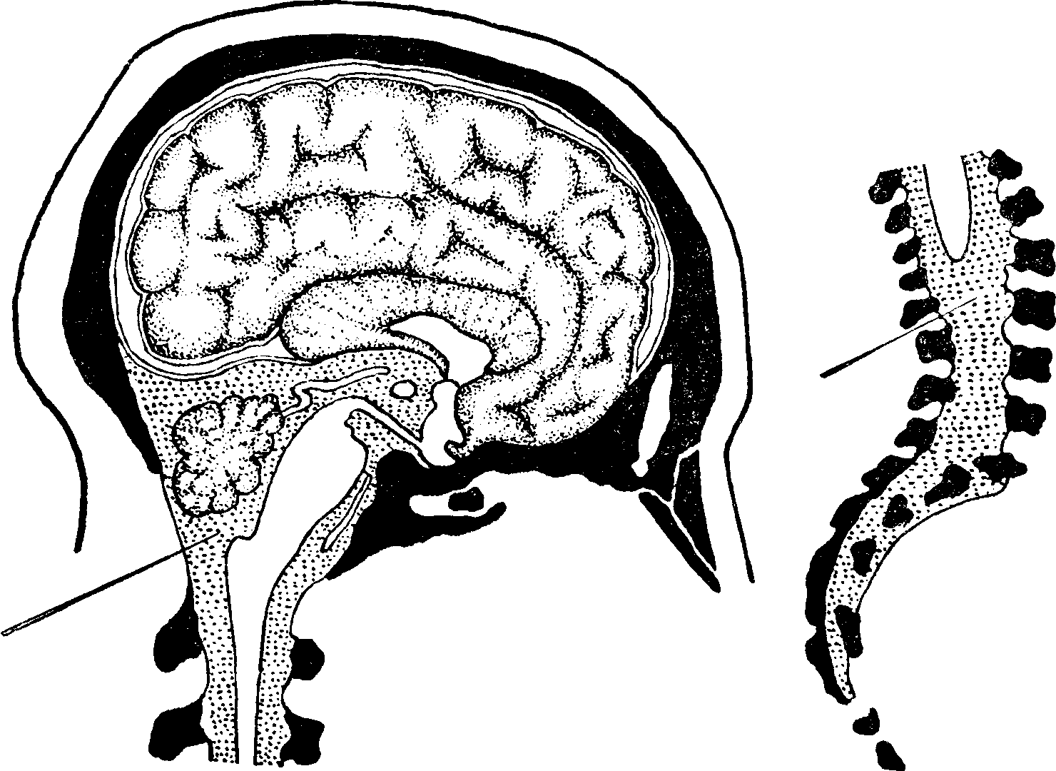 Ликворные изменения мозга