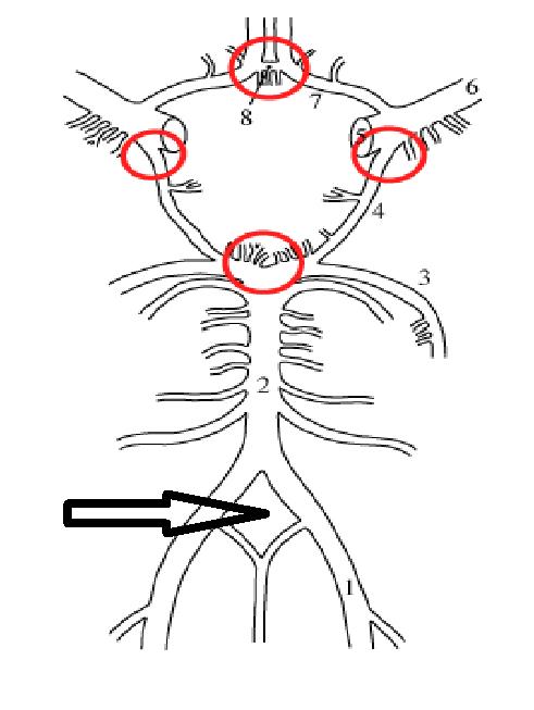 Развитие виллизиева круга в виде отсутствия кровотока