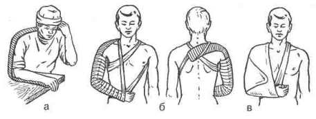 шина при повреждении плеча. шина при повреждении плеча. перелом плечевой кости шина крамера. иммобилизация плеча шиной крамера. транспортная иммобилизация при переломе костей плеча.