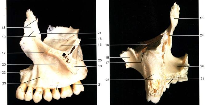 Клыковую ямку. Лобный отросток верхней челюсти анатомия. Клыковая ямка верхней челюсти. Верхнечелюстная кость анатомия. Крыловидный отросток верхней челюсти.