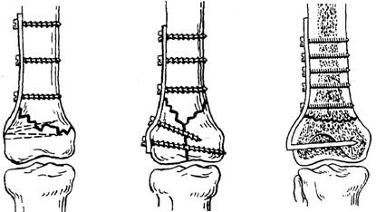 Остеосинтез мыщелка. Перелом мыщелка остеосинтез. Накостный остеосинтез бедренной кости. Переломы мыщелков бедренной кости. Чрезмыщелковый перелом большеберцовой кости.