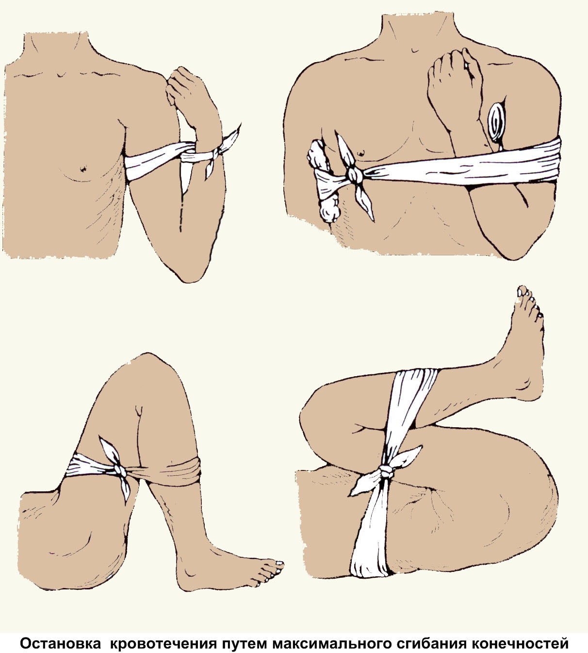 Метод максимального сгибания конечностей в суставе. Остановка кровотечения методом максимального сгибания конечности. Фиксирование жгута при кровотечении. Остановкакровотеечния. Остановка кровотечени.