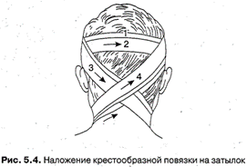 Крестообразная на затылок. Крестообразная повязка на затылок алгоритм. Крестообразная повязка на затылок и шею. Крестообразная повязка на голову. Крестообразная на затылок характеристика.