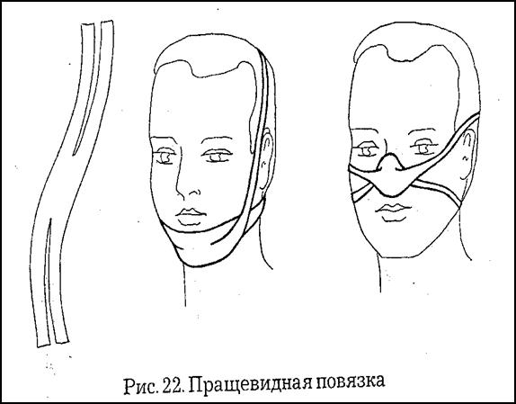 Пращевидная связка