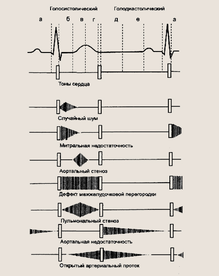 Аускультативная картина митральной недостаточности тест с ответами