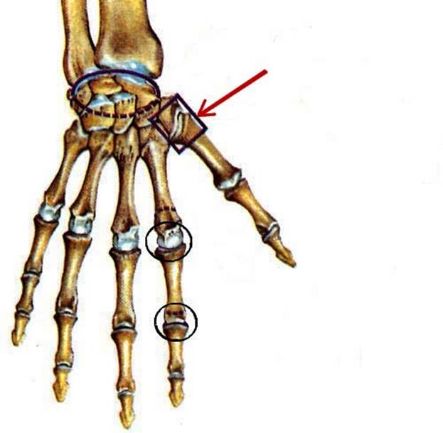 Соединения костей запястья. 1 Запястно пястный сустав. Пястно фаланговый сустав кисти. 1 Пястно-фаланговый сустав. Запястно-пястный сустав 1 пальца.